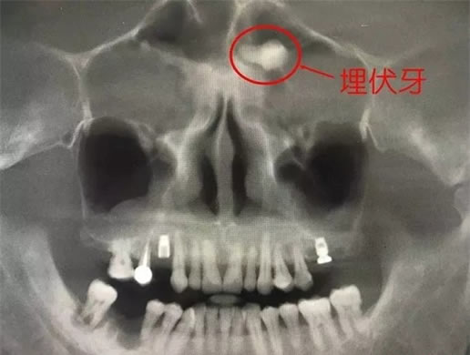 男子额头长一颗牙：清晰可见“埋伏牙”（图）