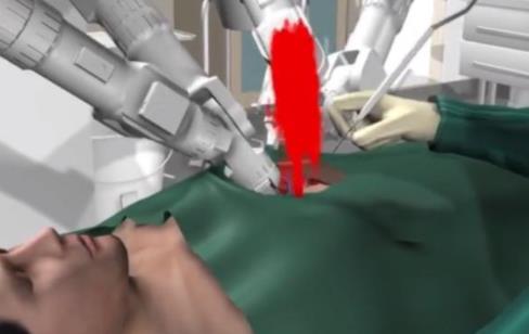 机器人心瓣手术：具体详情真相是怎么回事曝光