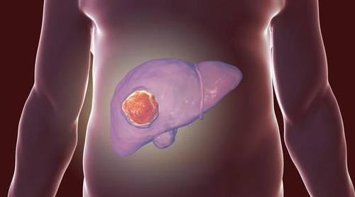 这病不痛不痒一旦发现就是晚期!(图文) 这病不痛不痒一旦发现就是晚期!(图文)