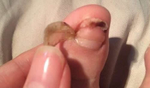 小伙脚趾莫名脱落:为什么会脱落患有什么病详情 小伙脚趾莫名脱落:为什么会脱落患有什么病详情