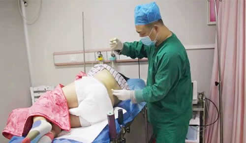 试点无痛分娩：试点工作方案（全文）