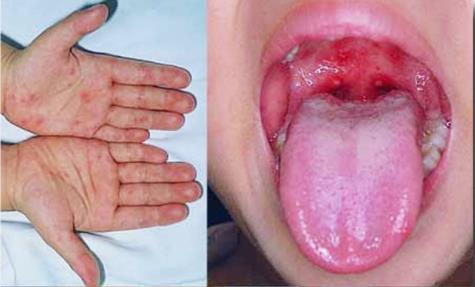 手足口病怎么治疗:什么叫手足口病图片