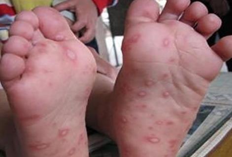 手足口病怎么治疗：什么叫手足口病图片
