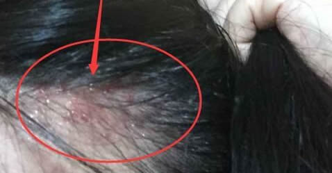 头上长疙瘩是什么情况：分析原因教你该怎么办