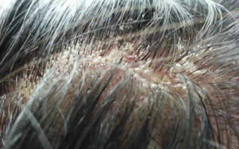 头上长疙瘩是什么情况：分析原因教你该怎么办