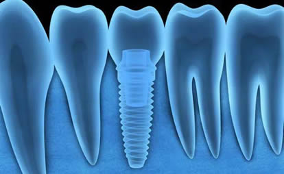 日本为什么禁止种植牙:日本禁止种植牙是真的吗 日本为什么禁止种植牙:日本禁止种植牙是真的吗