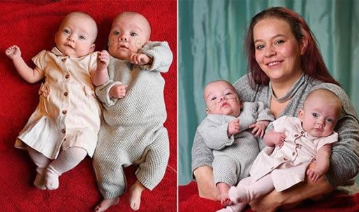 龙凤胎出生隔12天是怎么回事:罕见分娩全过程 龙凤胎出生隔12天是怎么回事:罕见分娩全过程