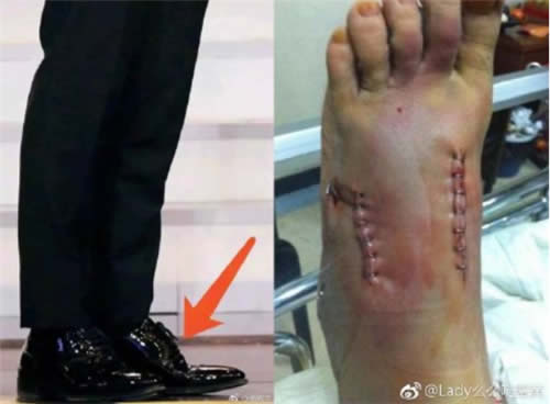 黄晓明增高鞋垫是什么情况：真相让人心疼（图）