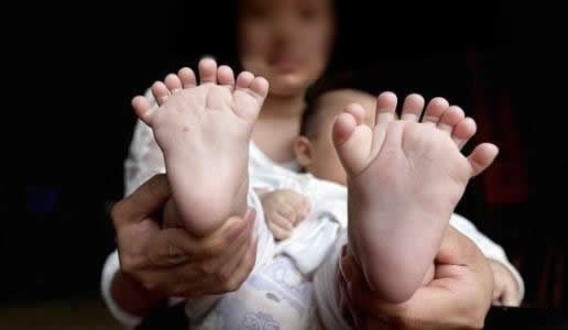 刚出生的宝宝31根指头？真相却让人心疼（罕见图）