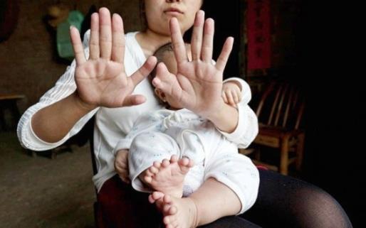 刚出生的宝宝31根指头？真相却让人心疼（罕见图）