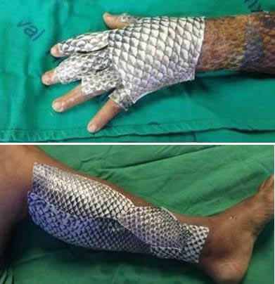 女子被大面积烧伤，医生植入鱼皮（奇迹图）