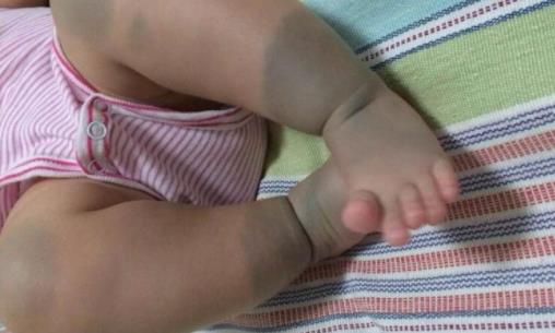 身上带有胎记的人是怎么回事:关于胎记的传说详解 身上带有胎记的人是怎么回事:关于胎记的传说详解