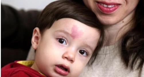 身上带有胎记的人是怎么回事:关于胎记的传说详解 身上带有胎记的人是怎么回事:关于胎记的传说详解