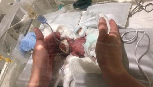 出生268克被称世界最小男婴:令人惊呆的体重现已平安 出生268克被称世界最小男婴:令人惊呆的体重现已平安