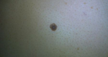 女人背部痣解读：老一辈人言女人后背长痣意思