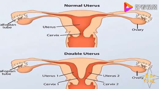 太罕见：女孩拥有2个子宫：这究竟是个什么梗？