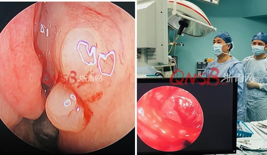 女孩鼻腔长出荔枝怎么回事：真相详情令人心疼