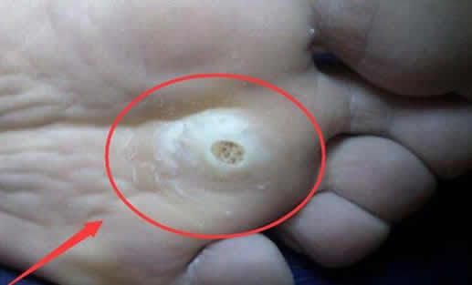 脚上长鸡眼怎么办:脚鸡眼图片大盘点(图) 脚上长鸡眼怎么办:脚鸡眼图片大盘点(图)