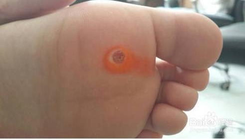 脚上长鸡眼怎么办:脚鸡眼图片大盘点(图) 脚上长鸡眼怎么办:脚鸡眼图片大盘点(图)