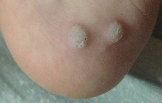 脚上长鸡眼怎么办:脚鸡眼图片大盘点(图) 脚上长鸡眼怎么办:脚鸡眼图片大盘点(图)