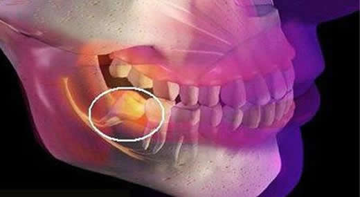 拔智齿后悔死了网友经历分享:什么情况下智齿不用拔 拔智齿后悔死了网友经历分享:什么情况下智齿不用拔