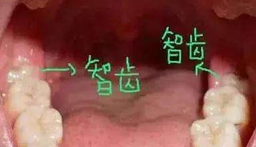拔智齿后悔死了网友经历分享:什么情况下智齿不用拔 拔智齿后悔死了网友经历分享:什么情况下智齿不用拔