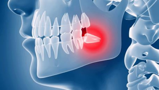 拔智齿后悔死了网友经历分享:什么情况下智齿不用拔 拔智齿后悔死了网友经历分享:什么情况下智齿不用拔
