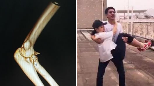 公主抱女友手骨折怎么回事:发生了什么骨折原因详情 公主抱女友手骨折怎么回事:发生了什么骨折原因详情