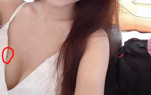 胸上有痣图片：男人女人胸上有痣含义