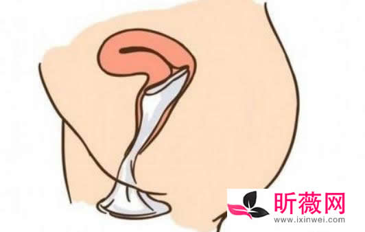 女士避用套：女用避孕套怎么戴（示范步骤图解）