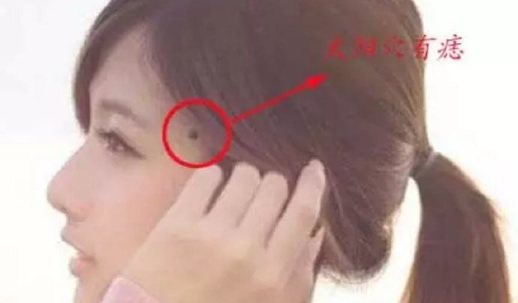 点痣女人巨富痣?三思而后行 点痣女人巨富痣?三思而后行