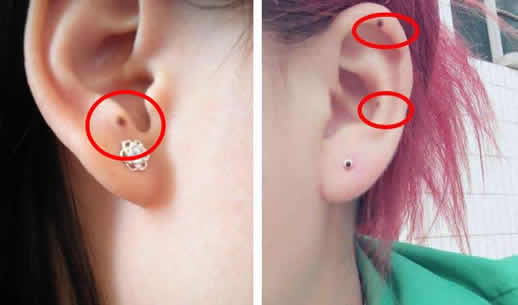 点痣女人巨富痣?三思而后行 点痣女人巨富痣?三思而后行