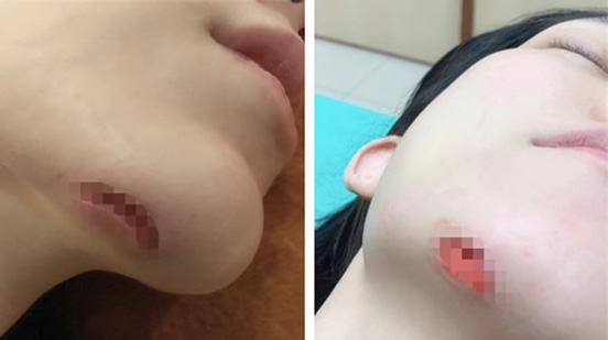 范玮琪回应摔伤：下巴受伤缝15针始末详情