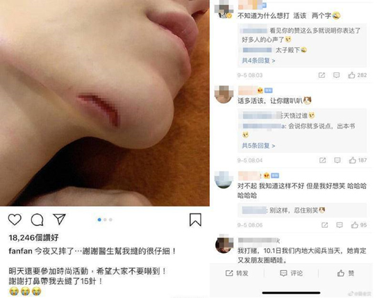 范玮琪回应摔伤：下巴受伤缝15针始末详情