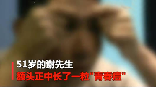 挤痘成恶性肿瘤:这到底是怎么回事 挤痘成恶性肿瘤:这到底是怎么回事