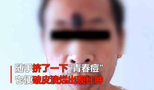 挤痘成恶性肿瘤:这到底是怎么回事 挤痘成恶性肿瘤:这到底是怎么回事