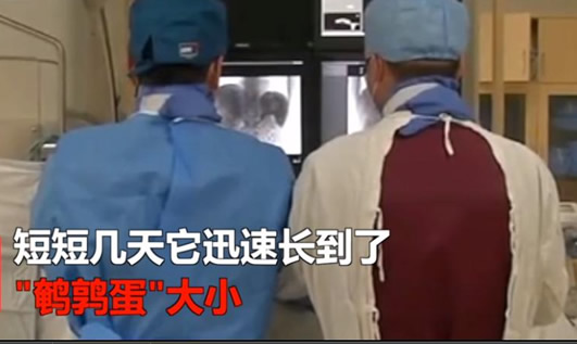 挤痘成恶性肿瘤:这到底是怎么回事 挤痘成恶性肿瘤:这到底是怎么回事