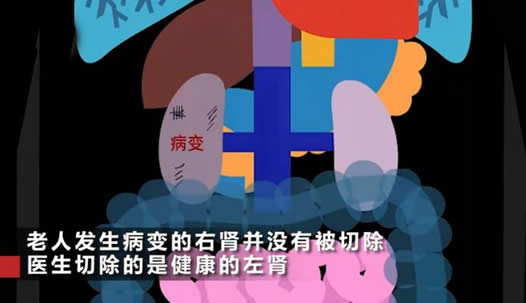 手术中遭误切左肾怎么回事：事件始末详情及后续结果