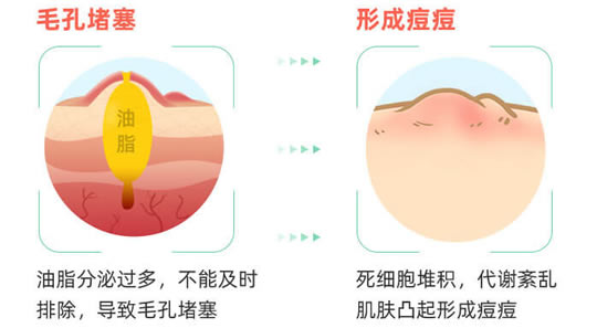 女人鼻子上长痘痘的原因:简单祛痘方法赶走鼻痘的烦心 女人鼻子上长痘痘的原因:简单祛痘方法赶走鼻痘的烦心