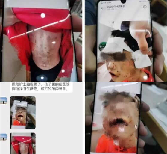 被虐打女童有生命危险仍昏迷 详情经过是? 被虐打女童有生命危险仍昏迷 详情经过是?