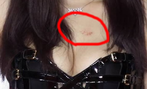 草莓印怎么快速消除 一大泼草莓吻痕图片