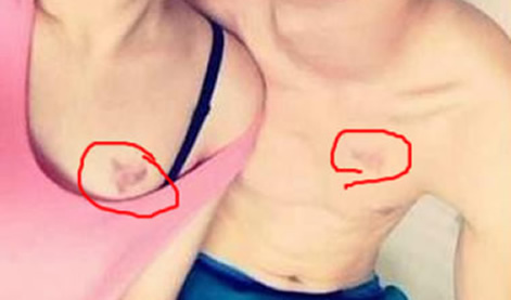 草莓印怎么快速消除 一大泼草莓吻痕图片