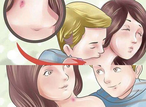 草莓印怎么快速消除 一大泼草莓吻痕图片