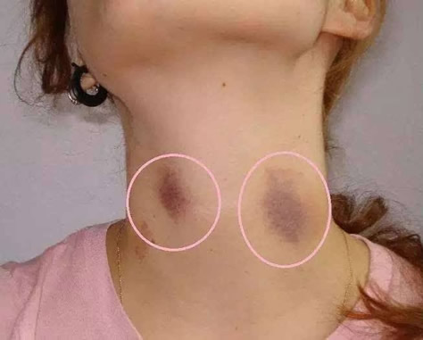 草莓印怎么快速消除 一大泼草莓吻痕图片