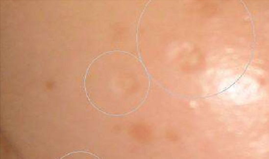 激光祛斑的危害与效果,很多女孩的脸被毁成这样了! 激光祛斑的危害与效果,很多女孩的脸被毁成这样了!