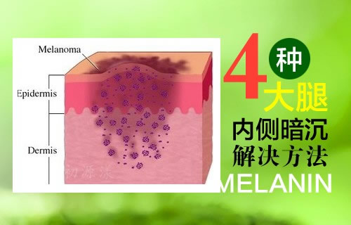 大腿内侧黑色素怎么去除?盘点有效的淡化黑色素小妙招 大腿内侧黑色素怎么去除?盘点有效的淡化黑色素小妙招