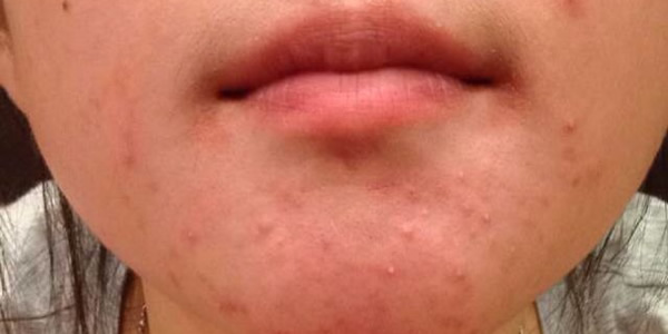 下巴反复长痘痘是什么原因 下巴反复长痘痘是什么原因