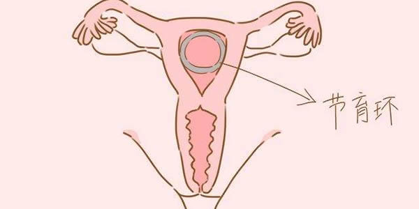 放环后有些女人会出现下肢或腰酸痛等身体状况,因为上避孕环对子宫
