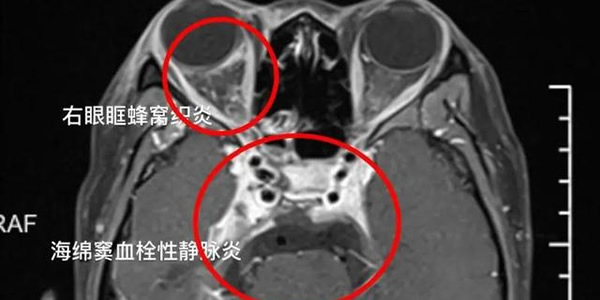 女孩挤痘引发颅内感染 挤痘痘的危害须知