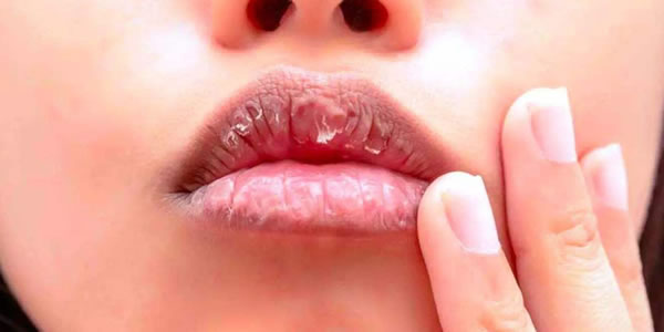 涂口红嘴巴起皮怎么办